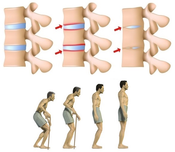 Bechtěrevova choroba, nemoc - byliny, bylinky, babské rady, čaj, koupel, mast, mazání