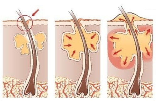 nezit zanet vlasoveho mazoveho vacku furunkl byliny bylinky babske rady obklady caje
