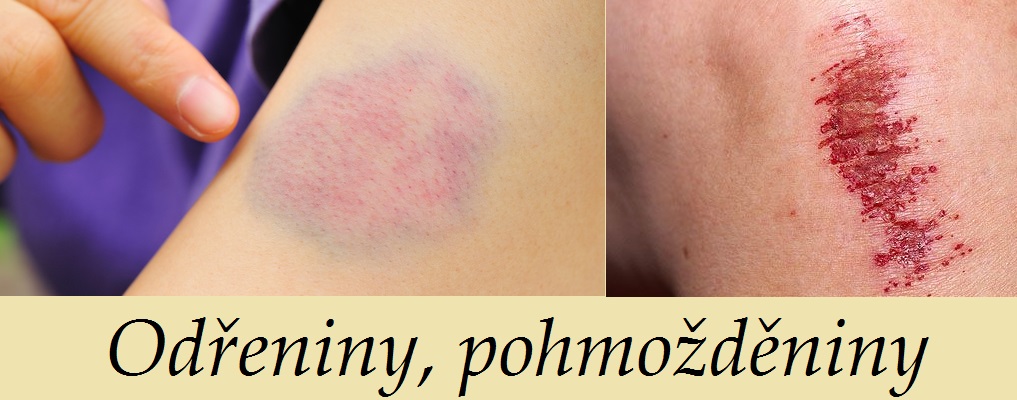 Odřeniny, pohmožděniny - byliny, bylinky, babské rady, obklad, mast, koupel, čaj