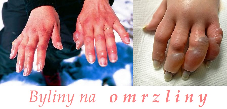 Omrzliny - byliny, bylinky, babské rady, koupel, mazání