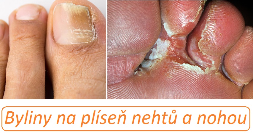 Plíseň nehtů, plíseň nohou - byliny, bylinky